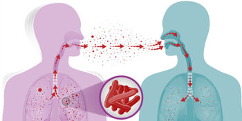 Tuberculosis Specialist – Best in Delhi, UP & India